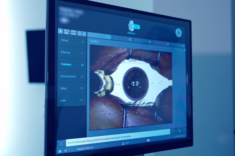 Cataract Surgery process