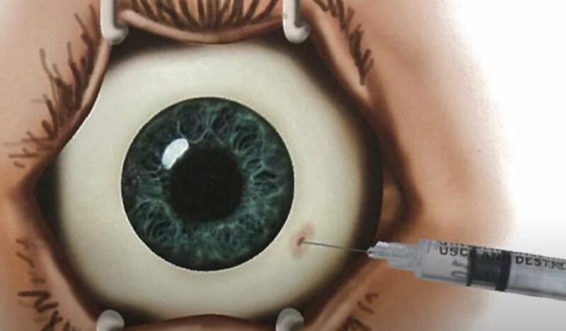 Understanding Eye Injections